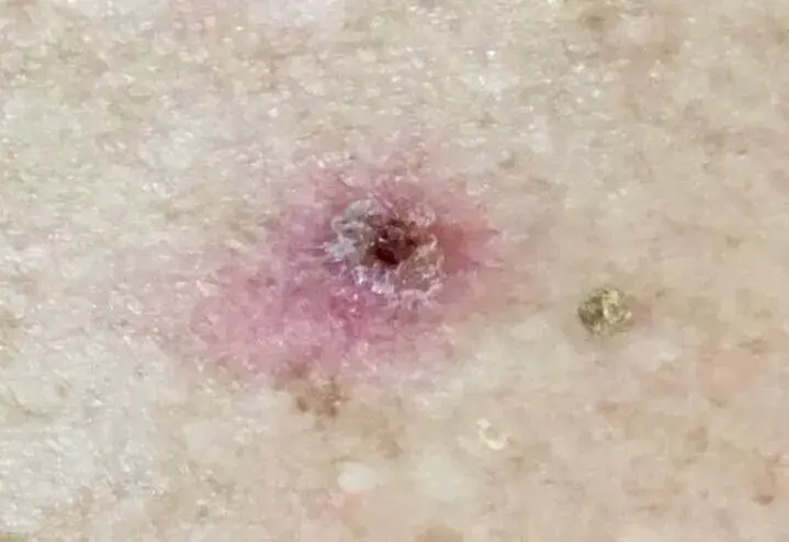 Cirugía de Carcinoma de Células Escamosas