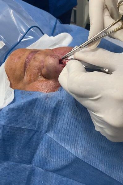 Cirugía de Mohs para Carcinoma Basocelular