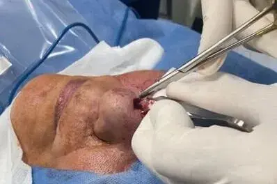 Cirugía de Mohs para Carcinoma Basocelular