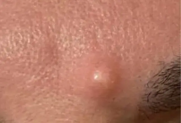 ¿Es necesario sacar los quistes de piel?