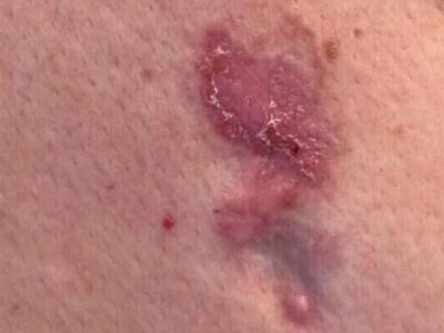 ¿Por que salen los carcinomas basocelulares?