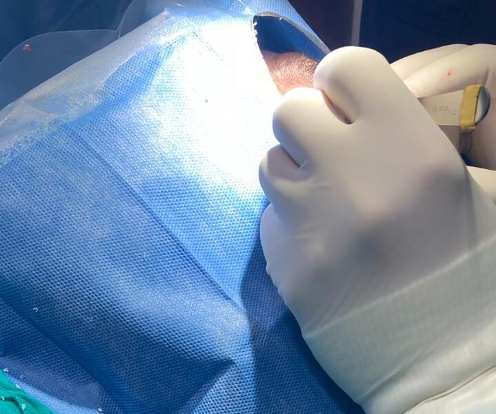 Margen comprometido en una biopsia de piel