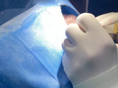 Margen comprometido en una biopsia de piel