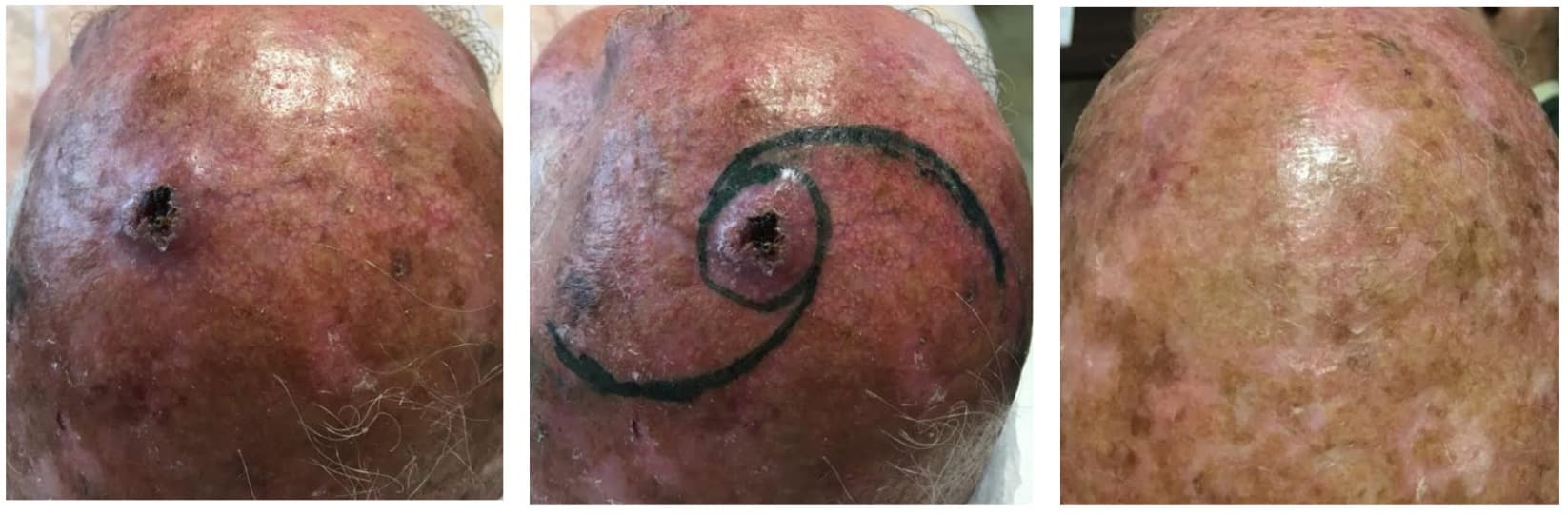 carcinoma basocelular en cuero cabelludo