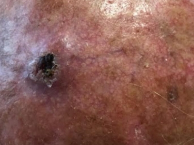 carcinoma basocelular en cuero cabelludo