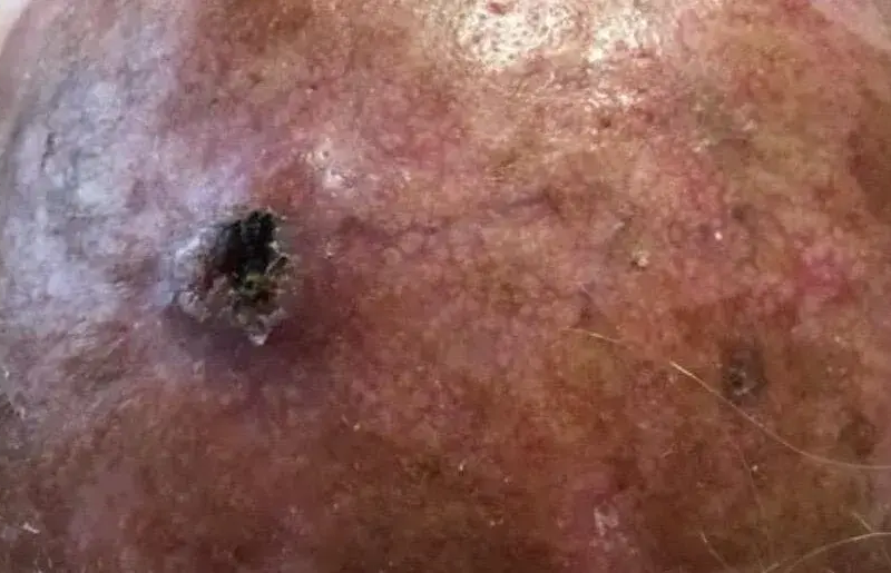 carcinoma basocelular en cuero cabelludo