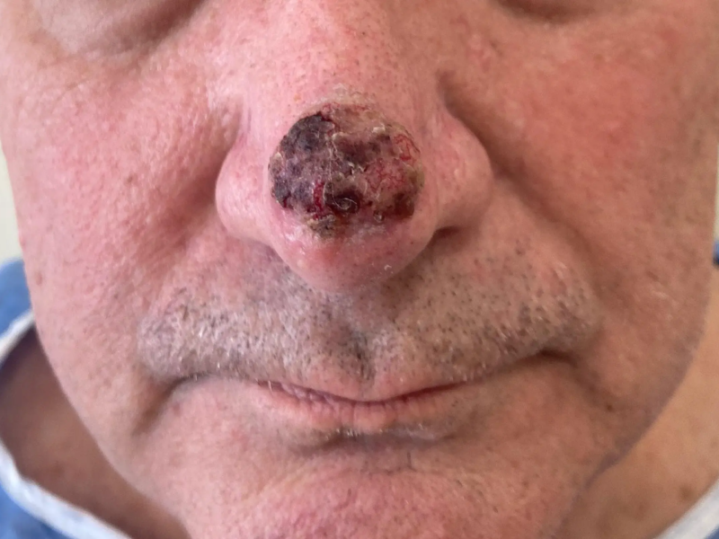 carcinoma basocelular en nariz