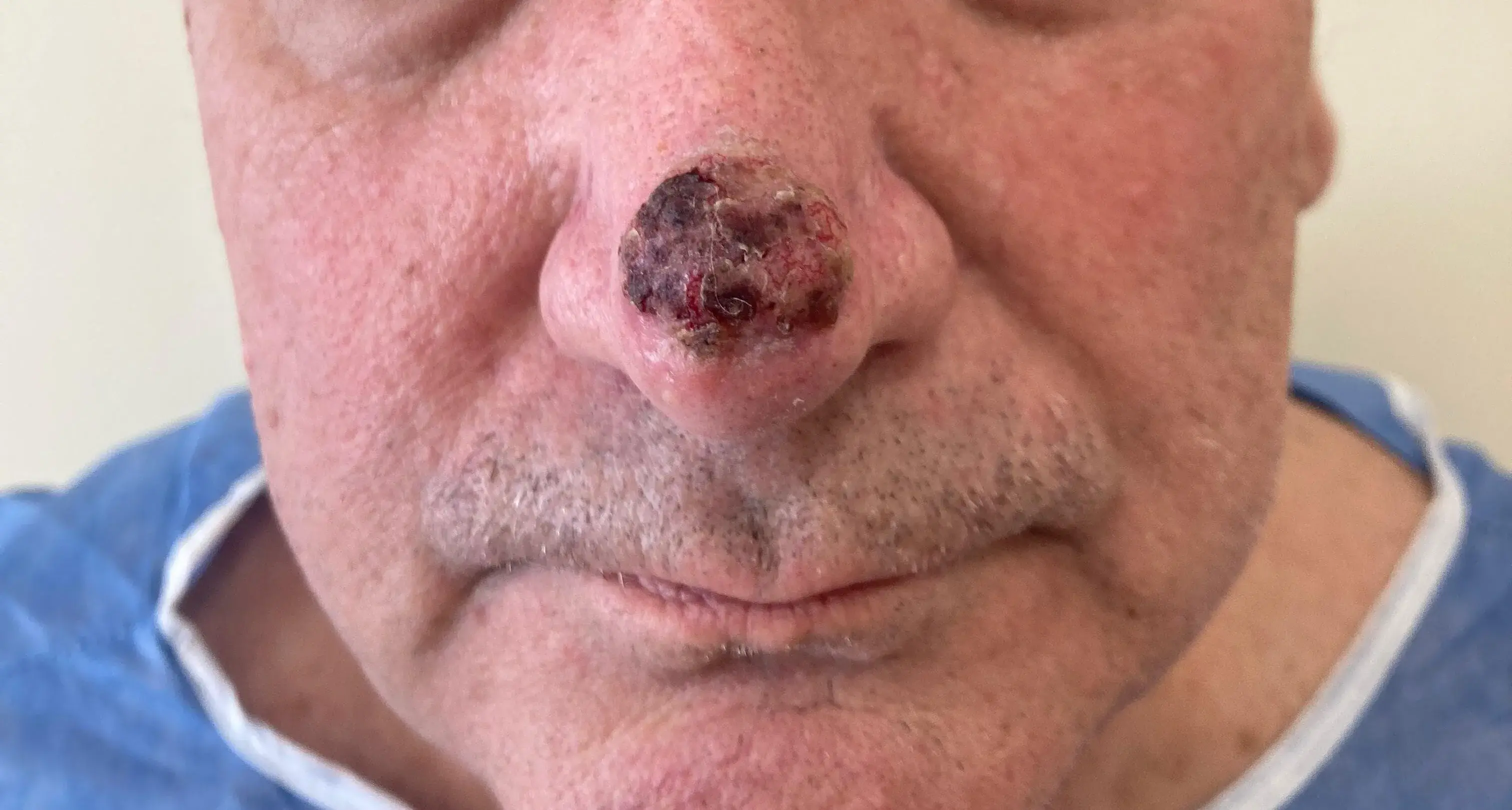 carcinoma basocelular en nariz