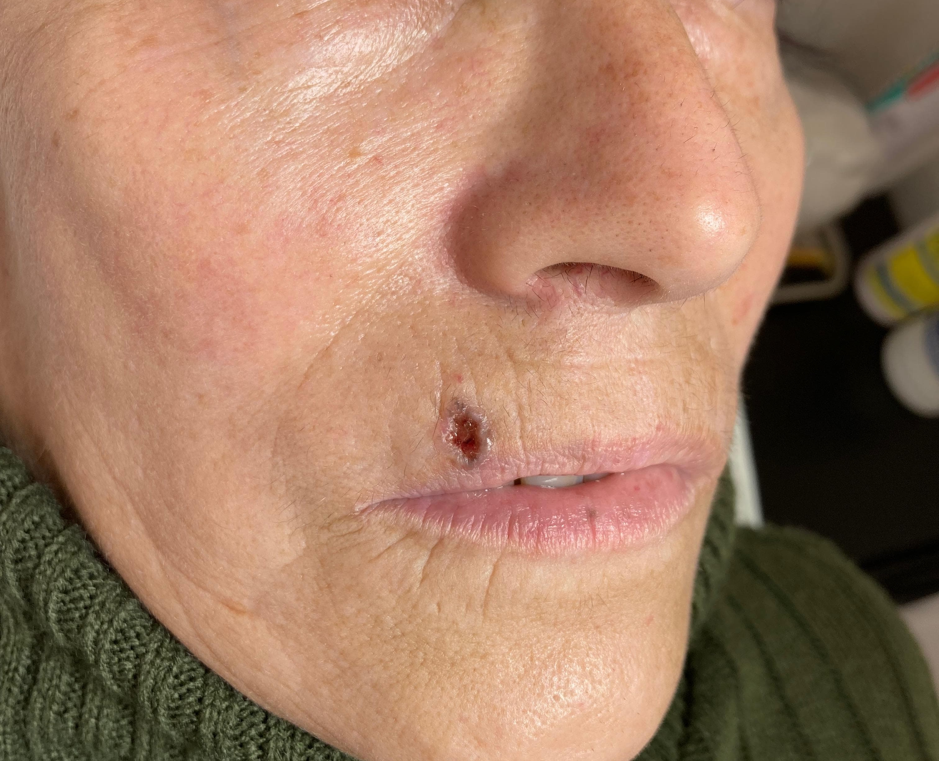 carcinoma basocelular sobre labio superior