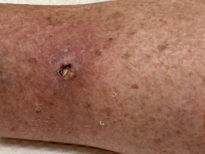 ¿Que es un carcinoma espinocelular?